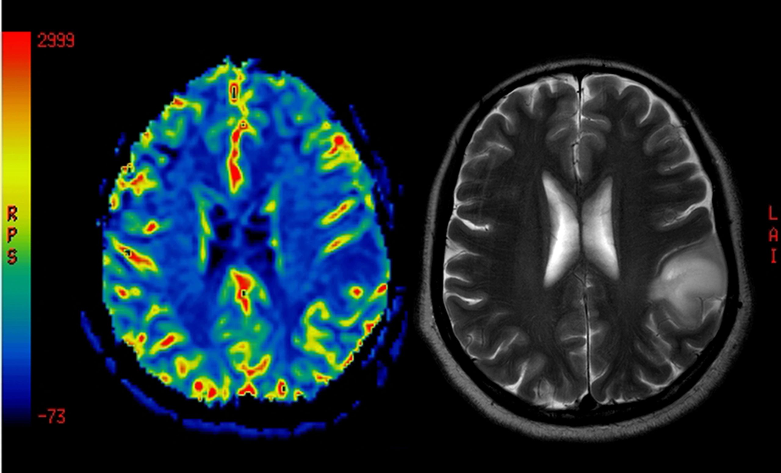 PET and MRI brain scan medical imaging